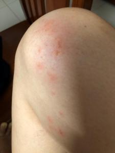 a close up of a persons shoulder with red spots on it at Motel Minh Thảo in Da Nang