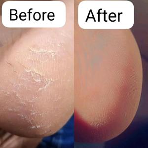 Primestay Homestead في غابورون: صورة مقربة لجلد شخص قبل وبعد العلاج